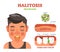 Halitosis. Bad breath vector illustration diagram poster.