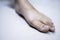 Hallux valgus or bunion are foot deformity of big toe that treat in orthopedic unit inside hospital.