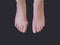 Hallux valgus, bunion in woman foot on black background. Overhead shot