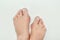 Hallux valgus, bunion in woman foot on white background