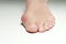 Hallux valgus, bunion in woman foot on white background