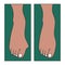 Hallux valgus, foot deformation