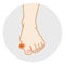 Hallux valgus - foot Trouble, Front view
