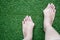 Hallux valgus, woman legs barefoot with bunions stand on green grass
