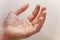 Hand with blister and callus on white background