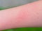 Hand with dermatitis red itchy swollen skin after touching nettle leaves sharp hairs. Plant Urtica dioica allergy