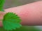 Hand with dermatitis red itchy swollen skin after touching nettle leaves sharp hairs. Plant Urtica dioica allergy