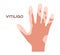 Hand and effect of vitiligo