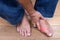 Hand embracing inflammed foot with painful gout on wooden floor