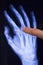 Hand and finger injury xray scan