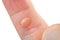 On hand finger there is blister callus with dry skin.