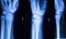 Hand finger thumb hospital xray scan