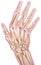 Hand and Fingers - Osteoarthritis of the Joints