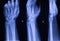 Hand fingers thumb wrist xray scan