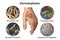 Hand fungal infection, tinea manuum, 3D illustration