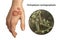 Hand fungal infection, tinea manuum, 3D illustration