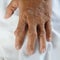 Hand of gout patient