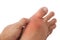 Hand holding Swollen Gout Inflamed Foot