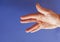 Hand of an man with Dupuytren contracture on blue