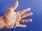 Hand of an man with Dupuytren contracture on blue