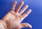 Hand of an man with Dupuytren contracture on blue