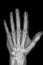 Hand radiography of a hospital patient