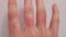 Hand of a sick person: bright red lesions on the fingers and tremor of the hands. Rash, allergic reaction, nervous irritation