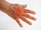 Hand suffering from joint pain with gout