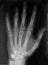 Hand xray