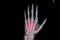 Hand xray showing fractured third and forth metacarpal bones