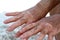 Hands with vitiligo skin condition