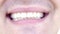 Handsome happy man smile with dental braces close up. Beautiful smiling man with brackets for teeth. Smiling man.