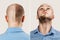 Happy Man before and after hair loss, alopecia. concept of baldness: the first man photo in front, the second - behind