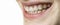 Happy smile of young woman with dental braces aligner
