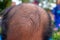 Head lose hair.Close up of head Asian man less hair. Glabrous