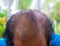 Head lose hair.Close up of head Asian man less hair. Glabrous