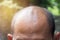 Head of man lose one`s hair, glabrous on his head for elderly ma
