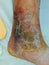 Healing leg ulcer