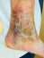 Healing leg ulcer