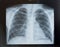 Healthy child chest x-ray:the ribs and lungs without damage