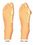 Healthy foot and foot with bunion