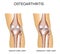 Healthy knee and knee with osteoarthritis