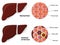 Healthy Liver and Cirrhosis