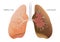 Healthy lung and cancer lung