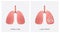 Healthy lung and lung infected with tuberculosis. Virus or bacterial infects lungsï¼ŒCoronavirus causing pneumonia of the lungs.