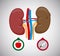 Healthy and sick kidney Illustration. Sick human internal kidneys organ. kidney cancer