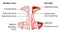 Healthy sinus and sinusitis, medical illustration, labeled