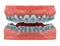 healthy teeth and classic metal braces, front view