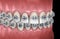 Healthy Teeth with metal braces. Medically accurate dental illustration
