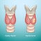 Healthy Thyroid and Thyroid Cancer. EPS10 Vector Illustration.